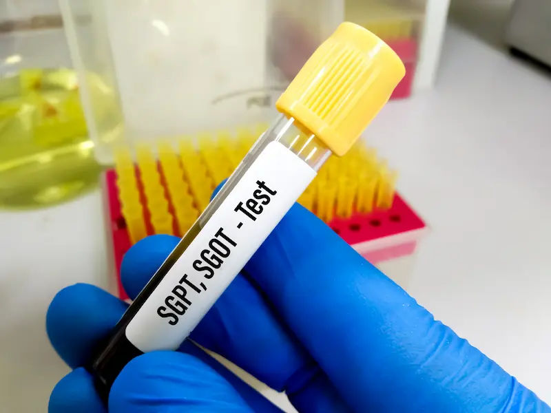 Guide to SGOT Test and Normal Range